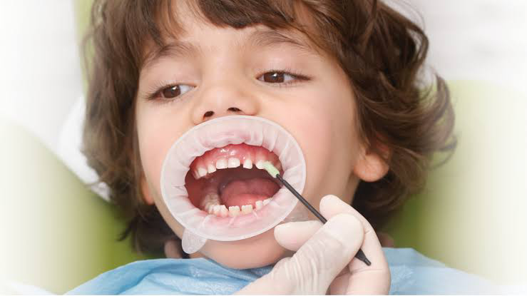 Ensuring Strong Smiles: The Vital Role of Fluoride Supplements in Pediatric Dentistry