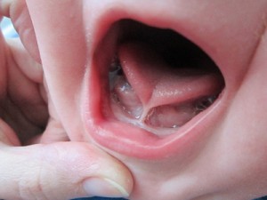 The Crucial Role of Lip and Tongue Tie Assessments in Newborns