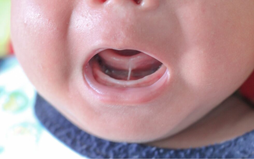 TongueTie and LipTie in Infants Dental Implications and Treatment